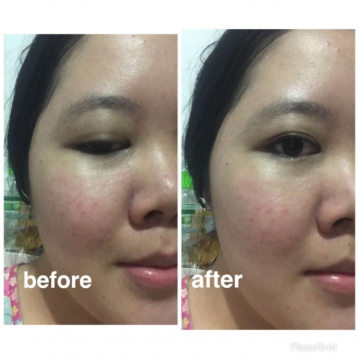 review sunscreen acne